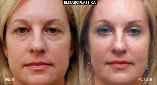 blefaroplastika