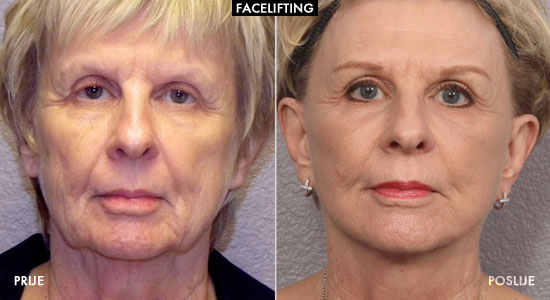 Facelifting