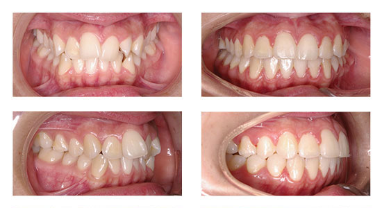 ortodoncija-2